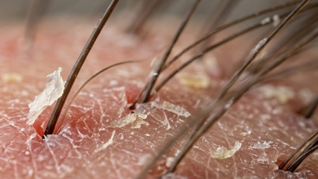 Dry Scalp and Dandruff Condition Close-up view of a dry, flaky scalp showing dandruff buildup around hair follicles and signs of scalp irritation.